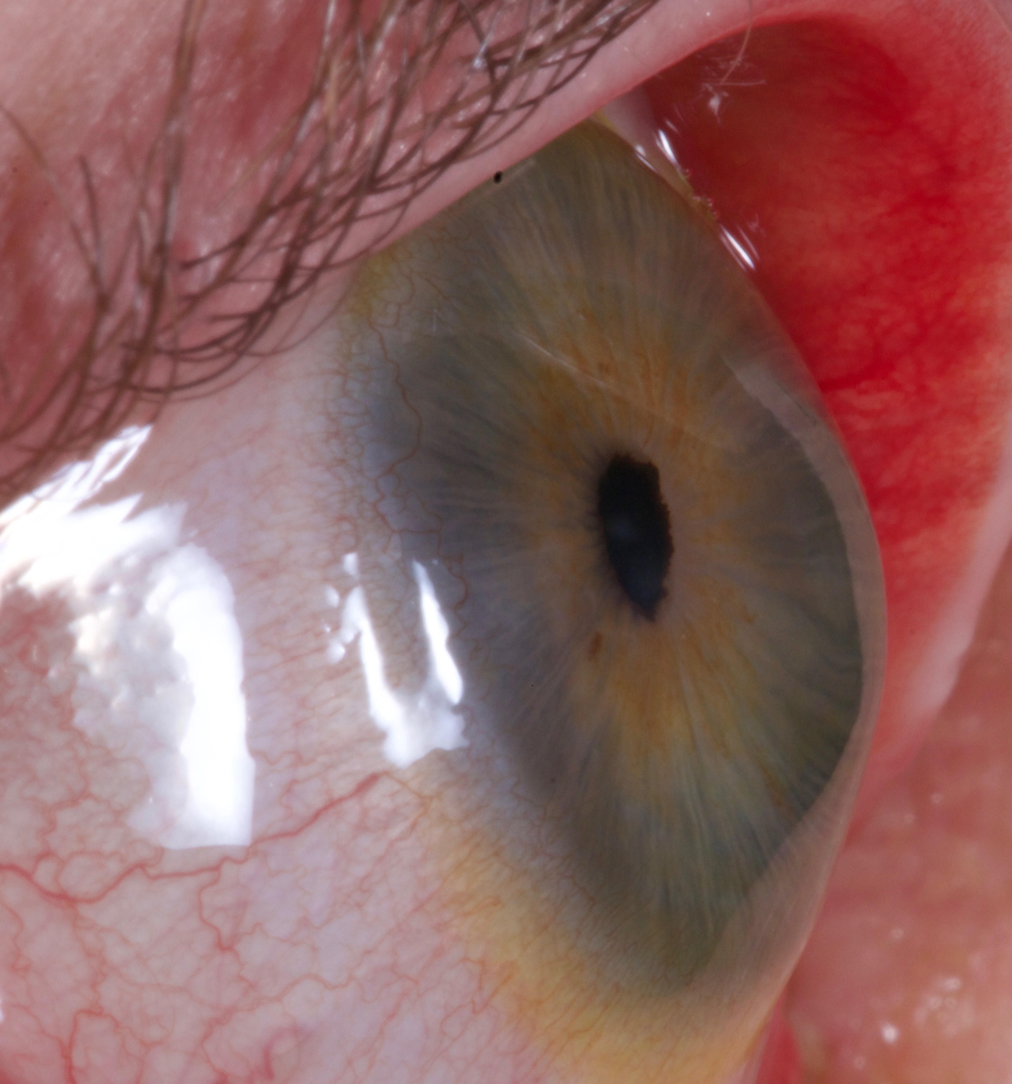Chapter 21 - Keratoconus: Diagnosis and Management With Spectacles and Contact Lenses