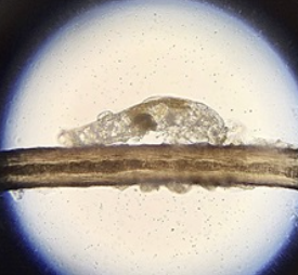 Demodex Blepharitis: A Comprehensive Review of the Disease, Current Management, and Emerging Therapies