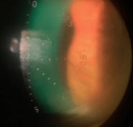 BCLA CLEAR Presbyopia: Management with contact lenses and spectacles
