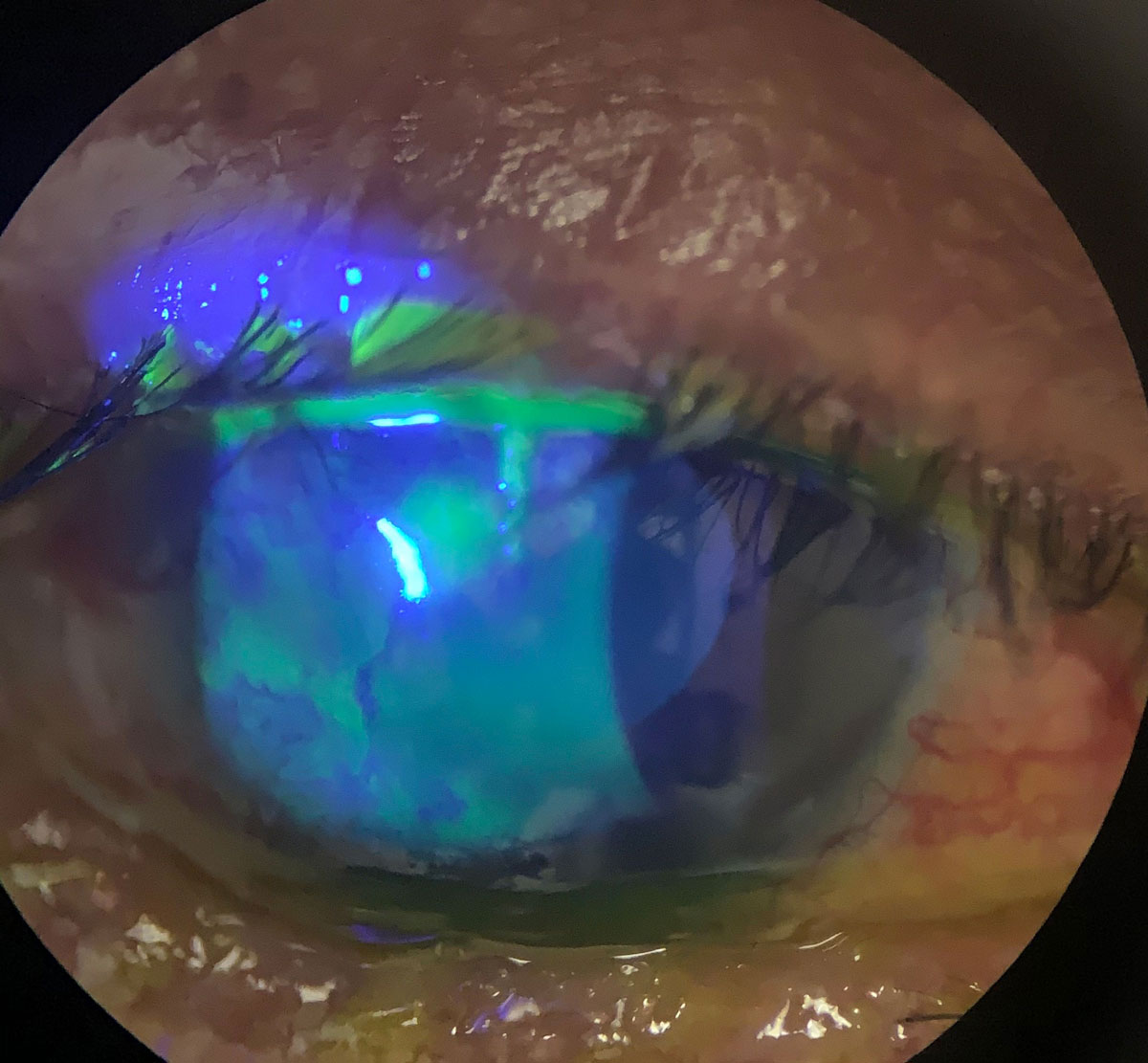 The Coming Rise of Drug-delivery Contact Lenses