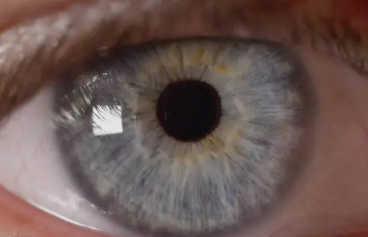 TFOS Lifestyle: Impact of contact lenses on the ocular surface
