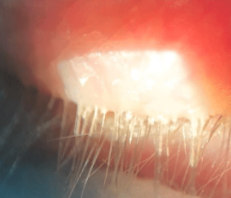 Demodex Blepharitis: A Comprehensive Review of the Disease, Current Management, and Emerging Therapies